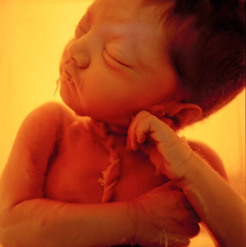 A foetus showing birth defects that continue to manifest among the gas-affected communities in Bhopal. Photo by Andy Moxom