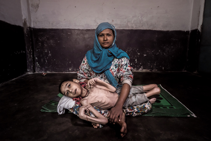 BHOPAL, INDIA: Sameer, 16 years old, held by his mother Wahida at home in the Jamalpura neighborhood.